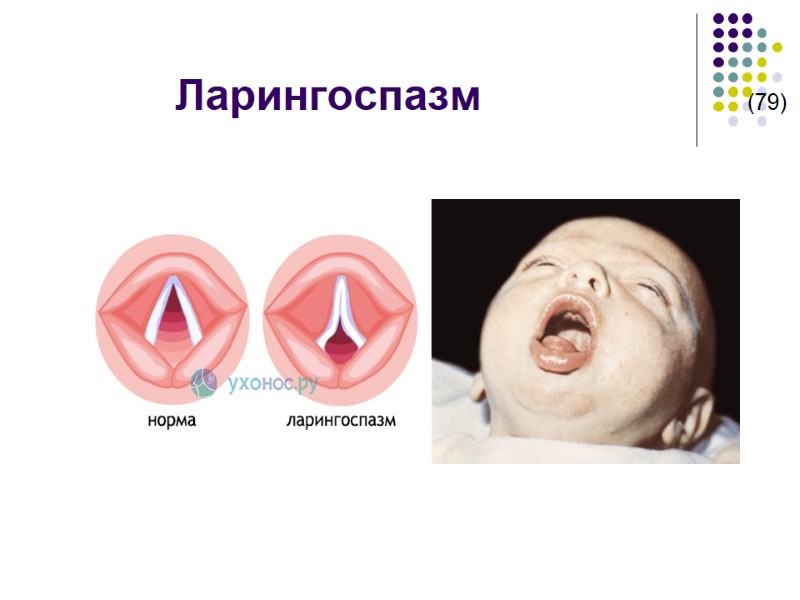 Ларингоспазм             